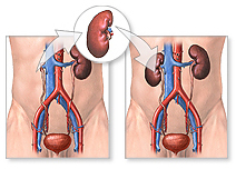 kidney-transplant surgery-Donor-Nephrectomy